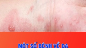 Một số bệnh về da thường gặp khi thời tiết chuyển từ Hè sang Thu